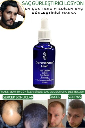 Saç Gürleştirici Serum Roller Mavi Şampuan Hediyeli - -5x50ml - 10